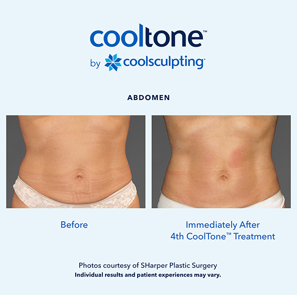 Cooltone before and after in a female's abdomen 3