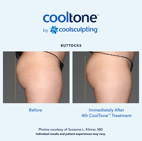 Cooltone before and after in a female's buttocks