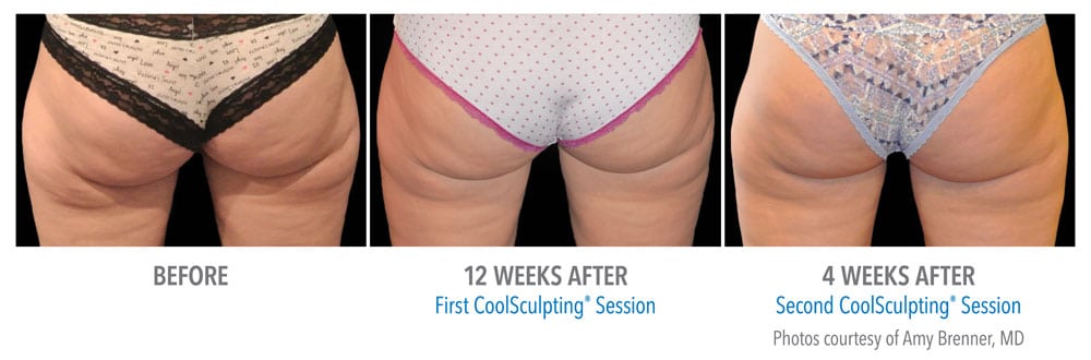 Before and after Coolsculpting on buttocks