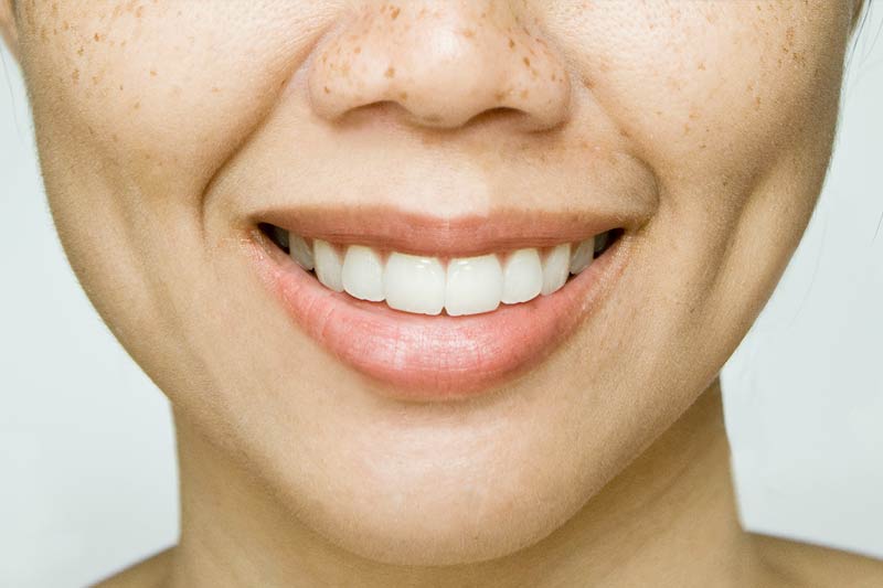 Botox for a wide nose