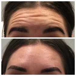 Botox in Phoenix before and after