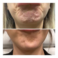 Botox in Phoenix before and after 2