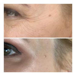 Botox in Phoenix before and after 3