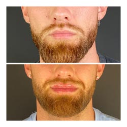 Dermal Fillers - Fuller lips before and after lip dermal fillers at Vibrant Skin Bar in Phoenix