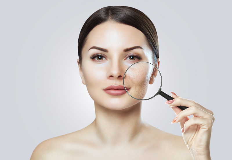 Best chemical peels for acne scars