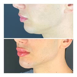 Dermal Fillers - Before and after lip dermal fillers at Vibrant Skin Bar in Phoenix featuring a young man