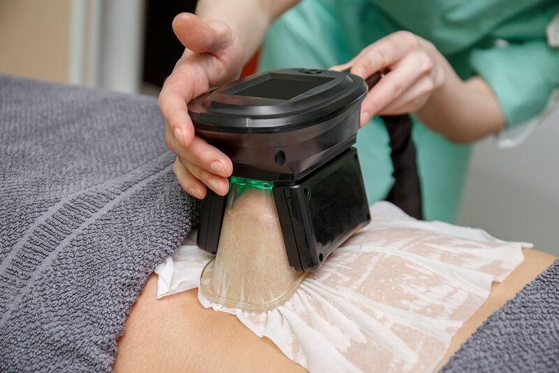 CoolSculpting for men: The procedure