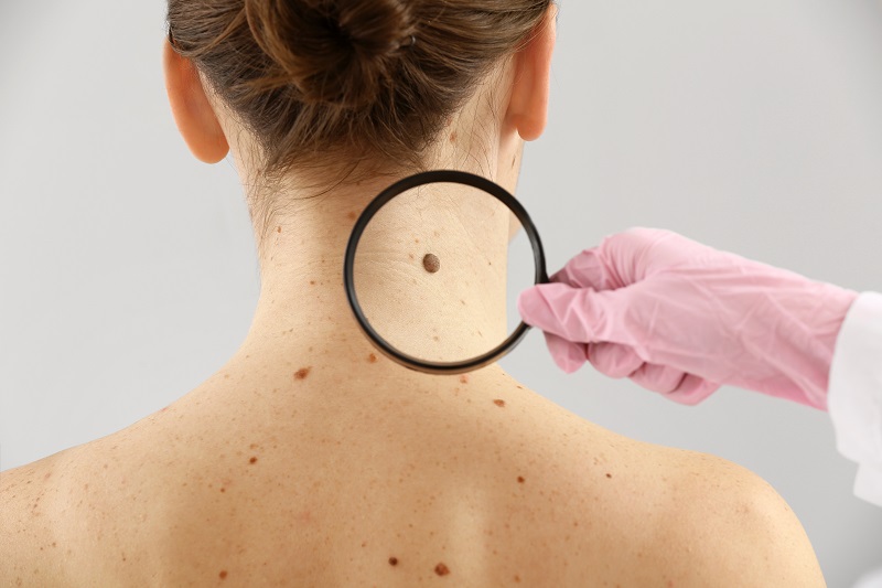 Reducing the risk of skin cancer is one of the Omega-3 benefits for the skin