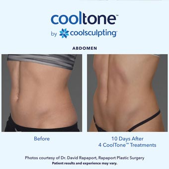 Cooltone before and after in a female's abdomen
