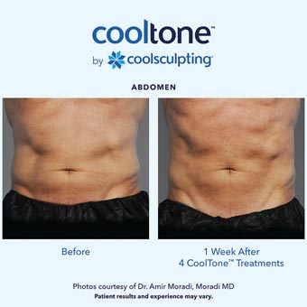 Cooltone before and after in a male's abdomen