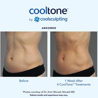 Cooltone before and after in a female's abdomen 2
